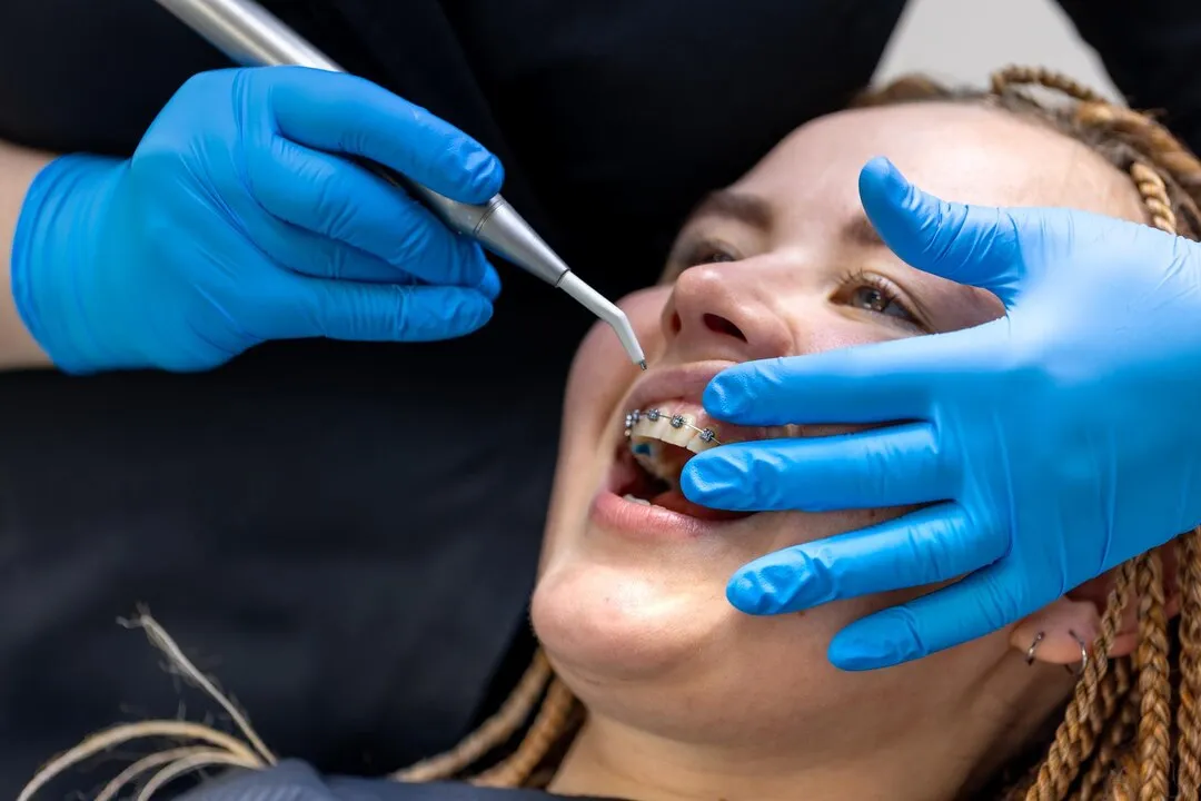 Dental Braces Types